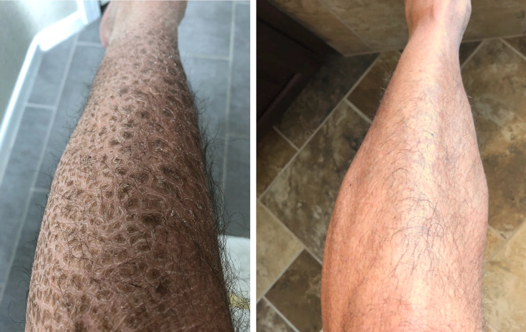 G16 Skin Repair Lotion | Ichthyosis Treatment Cream